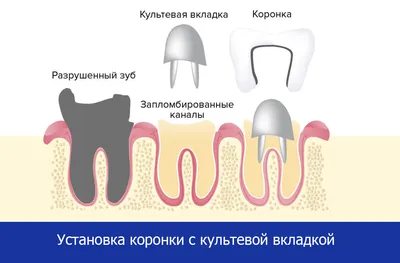 Культевая вкладка. Установка на передний и жевательный зуб в Москве и  области | НоваДент