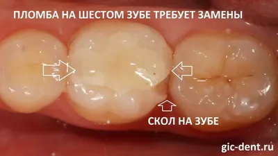 Цельнокерамические вкладки для 6 нижнего зуба - Немецкий имплантологический  центр