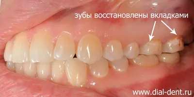 Восстановление зуба вкладкой после лечения пульпита