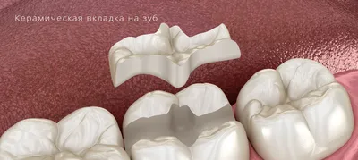 Керамическая вкладка на зуб [стоимость восстановление зуба]