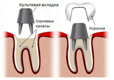 Культевая вкладка - цены на установку в стоматологической клинике  «Авангард» в Москве
