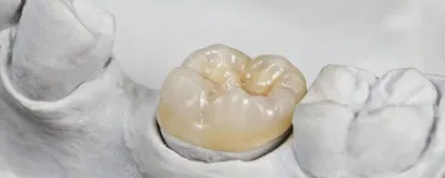 Зубная культевая вкладка под коронку в Феодосии, подготовка зуба к  установке коронки