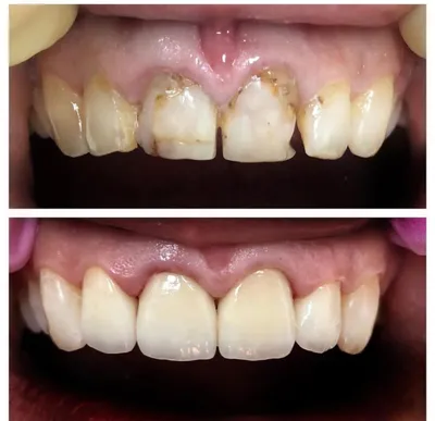 Вкладка на зуб: цена восстановления зуба керамической вкладкой в  стоматологии ИмплантТайм