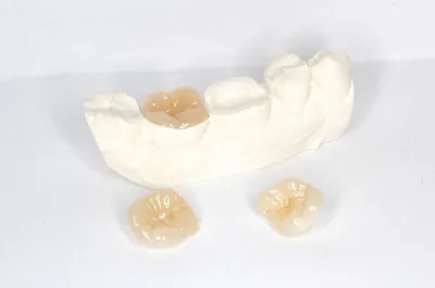 Изготовление керамических вкладок CEREC на зубы (зубных) в Челябинске: цены  от Dominanta74