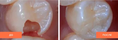 Керамические вкладки быстро набирают популярность как эффективный метод  восстановления поврежденного зуба. | SMAGA dental clinic