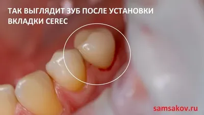 Зубные вкладки и зубные пломбы – в чем разница?