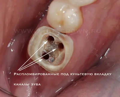 Зубные вкладки в стоматологии — плюсы и минусы, установка, показания —  Startsmile