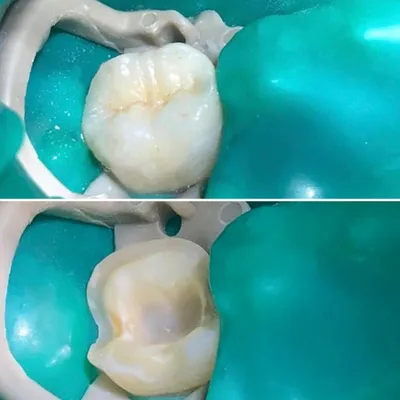 Керамическая вкладка на зуб в Самаре - Клиника Сатори