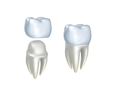 Вкладка на 37-ой зуб изготовленная в цифровом формате :: NORD DENTAL —  семейная стоматология. Две клиники на севере Петербурга