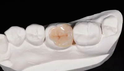 Керамическая вкладка на зуб: что это такое, восстановление зуба  цельнокерамической вставкой, плюсы и минусы