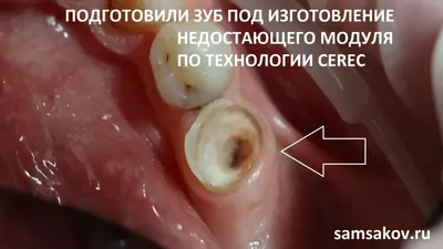 Керамическая вкладка E-max - цена в Москве | Вкладки в зуб | Авторская  клиника стоматологии доктора Муссурова