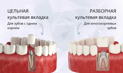 Композитные вкладки: назначение в стоматологии, плюсы и минусы