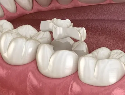 Керамические вкладки - современный метод реставрации зубов на длительный  срок