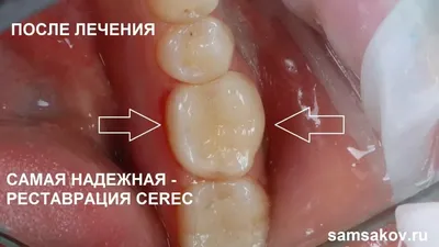 Почему вкладка на зуб лучше, чем пломба? | Стоматология Smile-at-Once | Дзен