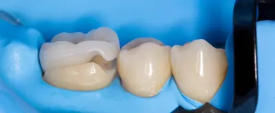 Вкладка в зуб под коронку: цена в Луховицах | Центр стоматологии доктора  Клименко - Мир Улыбки