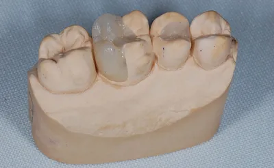 Микропротезирование зубов (вкладки) - Стоматологическая клиника Клевер