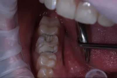 Зубная культевая вкладка под коронку: что это такое?