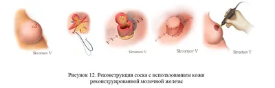 Рак груди начинается с этого: первые пять симптомов онкологии у женщин |  СИБ.ФМ | Дзен