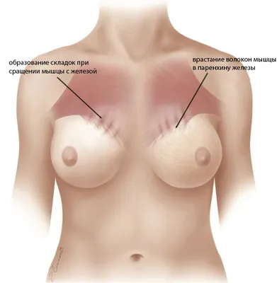Анимационная деформация молочных желёз после маммопластики (увеличения груди)  | Александр Маркушин пластический хирург