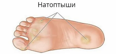 Бородавки | что это, причины возникновения, симптомы, виды, диагностика,  лечение и профилактика