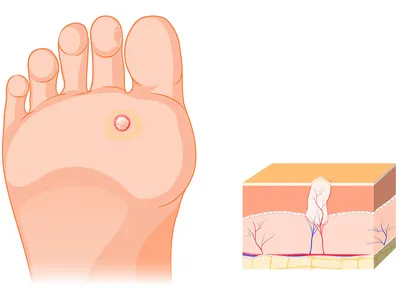 Подошвенная бородавка: как избавиться | ПульсПлюс | Дзен