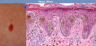 Сложный невус: меланоцитарный, пигментный, папилломатозный