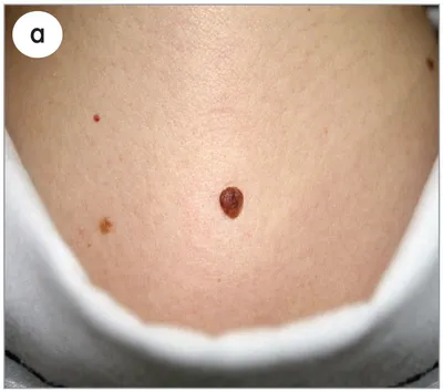 Melanoma Unit on Instagram: \"Внутридермальный невус (он же бородавчатый, он  же папилломатозный) - врожденный или приобретенный доброкачественный пигментный  невус, невусные клетки которого расположены в дерме. Такое образование чаще  всего подвергается ...