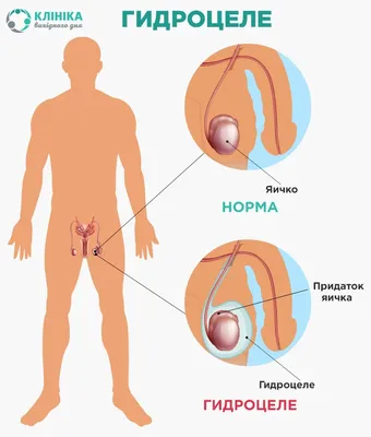 Лечение водянки яичка без операции - IMS Clinic