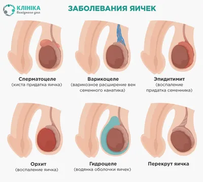 Водянка яичка у мужчин: фото до и после операции при водянке яичка. Причины  и лечение водянки оболочек яичка