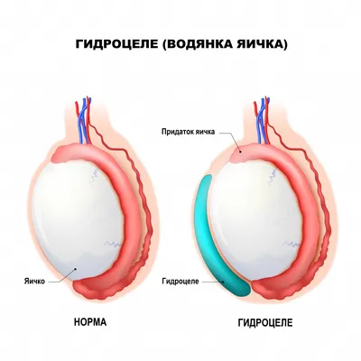 Лечение варикоцеле у мужчин (операция), детей и подростков