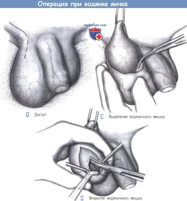 Гидроцеле (водянка яичка): симптомы, причины и лечение в клинике АльтраВита