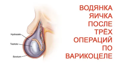 Это история нашего пациента, у которого была водянка яичка, или гидроцеле.  Мошонка увеличивалась постепенно,.. | ВКонтакте