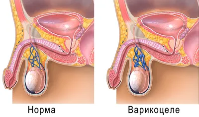 Лазерное удаление водянки яичка — Клініка «РоміТаль»