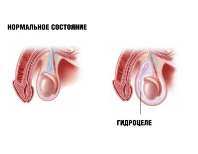 Водянка яичка (гидроцеле): причины возникновения, симптомы, последствия  операции