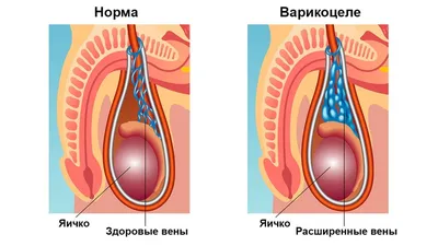 Варикоцеле: что это такое, как проявляется, как его лечат | Клиника Эксперт