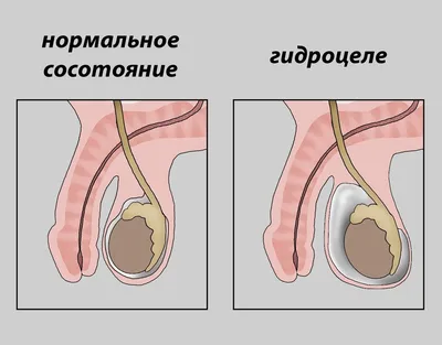 Лапароскопия варикоцеле у мальчиков, лечение, удаление у детей, цена  хирургической операции. | Москва