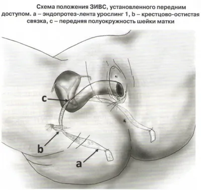 Водянка оболочек яичка (гидроцеле) операция – Лечение водянки у  новорожденных мальчиков в центре андрологии в Москве!