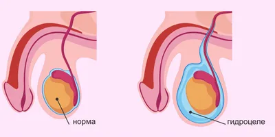Водянка яичка (лечение гидроцеле): симптомы, диагностика и лечение в  клинике Universum Clinic