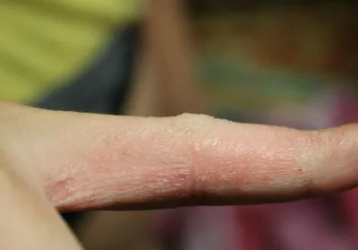 Красная влажная водянка на пальце на руке, макрос мозоли, каллюс на коже,  воспаление Стоковое Фото - изображение насчитывающей перст, проблема:  148817636