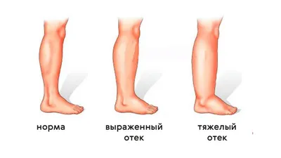 10 САМЫХ ЭФФЕКТИВНЫХ народных способов как избавиться от отеков ног.  Средства проверенные годами - YouTube