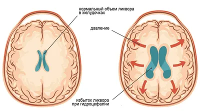 Лечение флегмоны – лечение в Москве в клинике доктора Назимовой