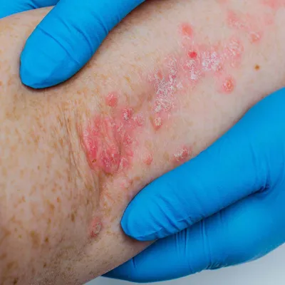 Луиза-Мишель Сулейман - РОЗОВЫЙ ЛИШАЙ Это инфекционно-аллергическое  заболевание кожи, характеризующееся пятнистыми высыпаниями. Среднее время  течения болезни — от 4 до 6 недель, в редких случаях — до полугода.  Существует мнение, что данная