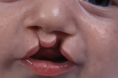 Заячья губа у детей: фото, причины, симптомы, лечение