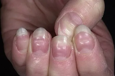 Волнистые ногти у ребенка (58 фото)