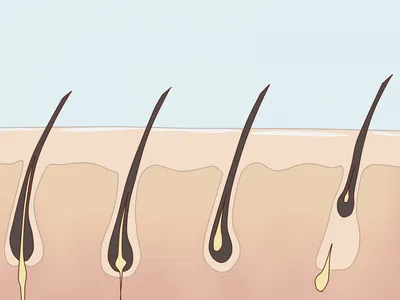 Как лечить вросшие волосы после шугаринга? - YouTube