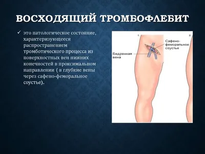 Варикозное расширение вен | Презентации Хирургия | Docsity