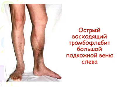 Лечение тромбофлебита ⋆ varicose.kiev.ua