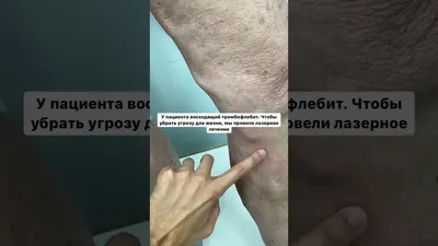 Минифлебэктомия вен в СПб - цена операции по удалению варикозных вен через  микроскопические надрезы и проколы в клинике Груздева