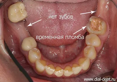 Имплантация двух нижних зубов с пластикой мягких тканей