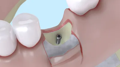 Белая десна после имплантации говорит о серьезных проблемах | Полезные  статьи | 100 Баллов